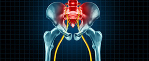 Sciatica Treatment Specialist Near Me in Frisco, TX and Denton, TX